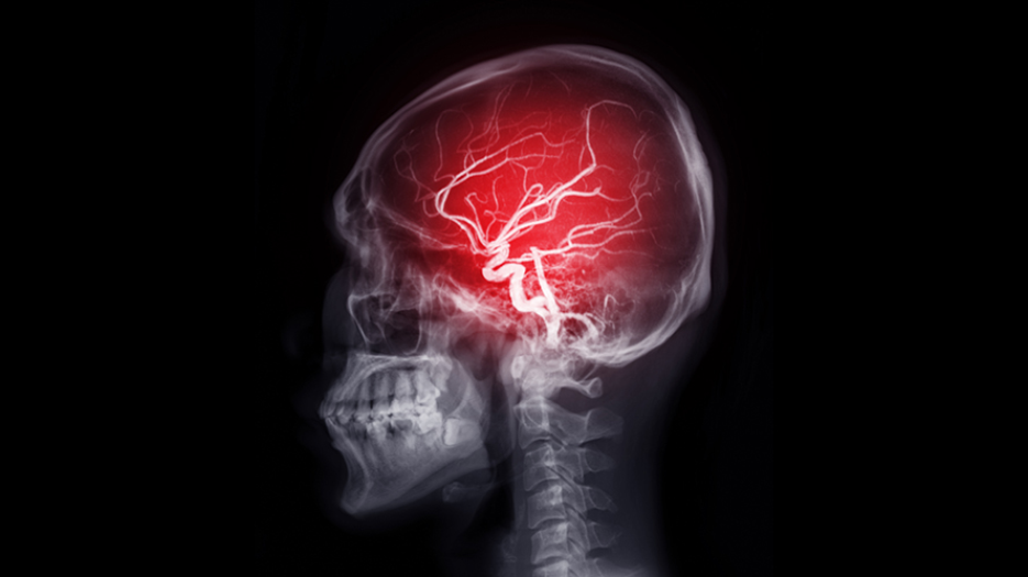 MRI image of skull with brain's blood vessel within, and a bright red spot to indicate a blood clot causing a stroke
